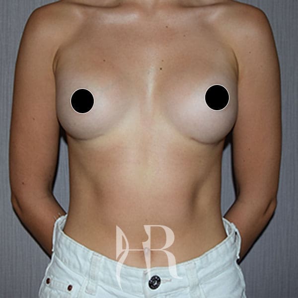 HR Plastic Surgery - Breast Enlargement patient after 4